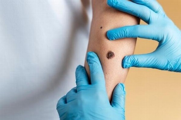 Cómo identificar melanoma, por exposición prologada al sol