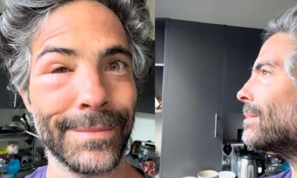 ¡Osvaldo Benavides aparece con el rostro inflamado! (+video)